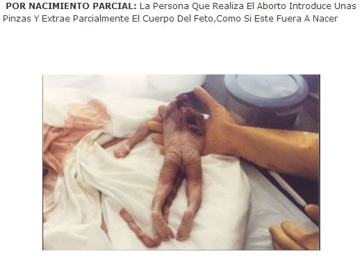 abortoNacimParcial